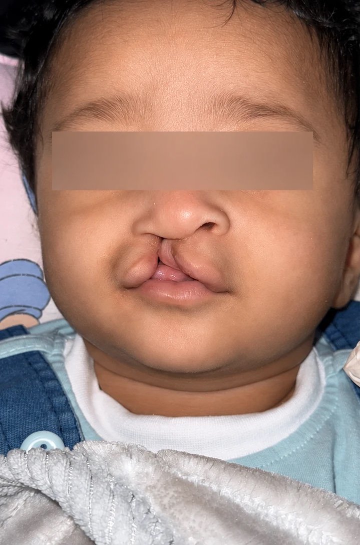 قبل إصلاح الشفة الأرنبية وسقف الحلق — د. علي عبدالله ال مجلي