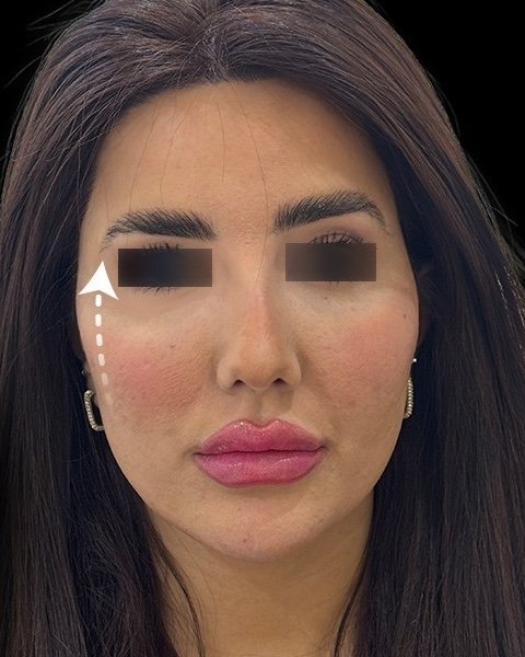 بعد عمليات تجميل الجفون ورفع الحاجب — د. علي عبدالله ال مجلي