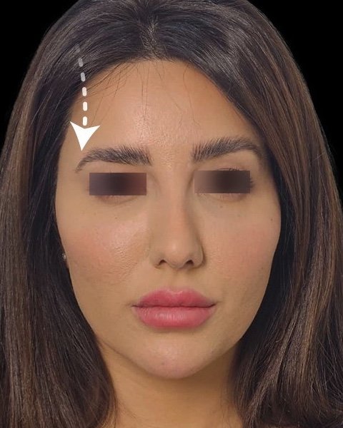 قبل عمليات تجميل الجفون ورفع الحاجب — د. علي عبدالله ال مجلي