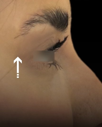 بعد عمليات تجميل الجفون ورفع الحاجب — د. علي عبدالله ال مجلي