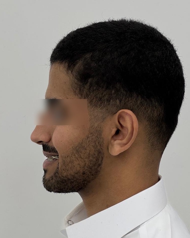بعد جراحة الفكين التقويمية — د. علي عبدالله ال مجلي
